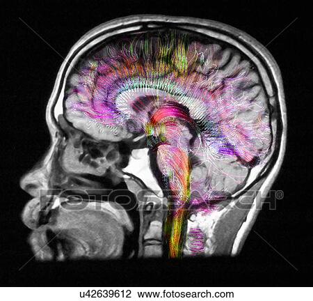 Stock Image - "Diffusion MRI, also referred to as diffusion tensor imaging or DTI, of the human brain". Fotosearch