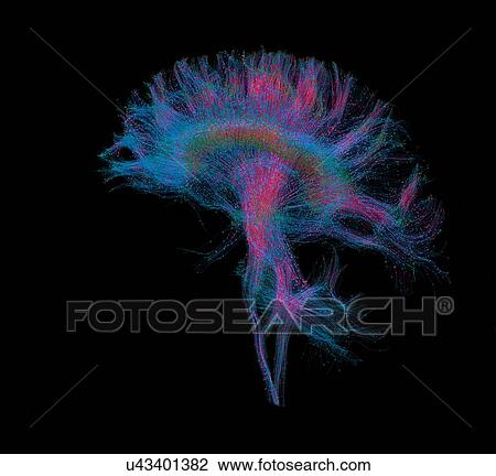 Stock Image - "Diffusion MRI, also referred to as diffusion tensor imaging or DTI, of the human brain". Fotosearch