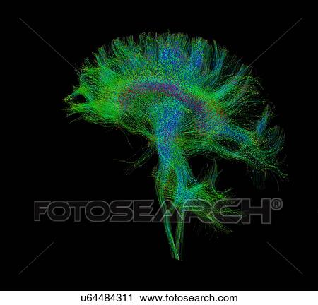 Stock Image - "Diffusion MRI, also referred to as diffusion tensor imaging or DTI, of the human brain". Fotosearch