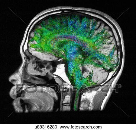 Stock Image - "Diffusion MRI, also referred to as diffusion tensor imaging or DTI, of the human brain". Fotosearch