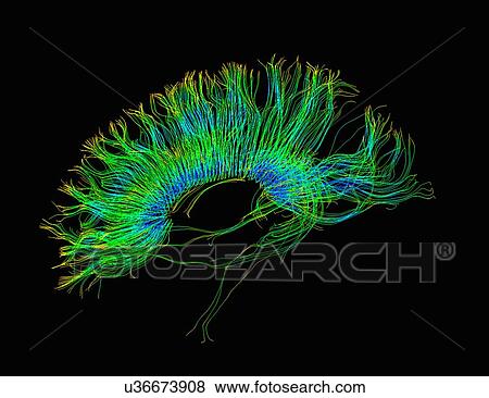 Stock Photo - "Diffusion MRI, also referred to as diffusion tensor imaging or DTI, of the human brain". Fotosearch