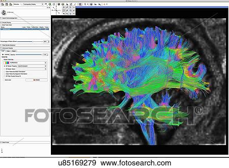 "Diffusion MRI, also referred to as diffusion tensor imaging or DTI, of the human brain" View Large Photo Image Stock Photo - "Diffusion MRI, also referred to as diffusion tensor imaging or DTI, of the human brain". Fotosearch