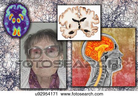 "Elderly woman with Alzheimer's disease, illustration of brain section from person with Alzheimer's, scan of person affected by Alzheimer's, illustration of plaque accumulation in Alzheimer's" View Large Photo Image Stock Image - "Elderly woman with Alzheimer's disease, illustration of brain section from person with Alzheimer's, scan of person affected by Alzheimer's, illustration of plaque accumulation in Alzheimer's". Fotosearch