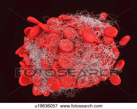 Illustration of a blood clot showing a clump of red blood cells intertwined in a fibrin mesh View Large Photo Image Stock Photo - Illustration of a blood clot showing a clump of red blood cells intertwined in a fibrin mesh. Fotosearch