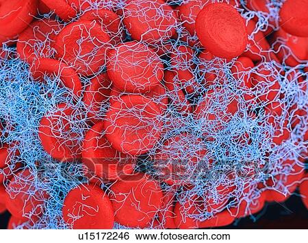 Illustration of a blood clot showing a clump of red blood cells intertwined in a fibrin mesh View Large Photo Image Stock Photograph - Illustration of a blood clot showing a clump of red blood cells intertwined in a fibrin mesh. Fotosearch