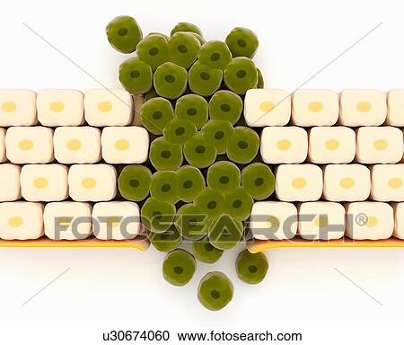 Stock Image - Illustration of tumor cells breaking through the tissues in the body. Fotosearch