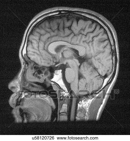 MRI of head showing normal brain structures View Large Photo Image Stock Photograph - MRI of head showing normal brain structures. Fotosearch