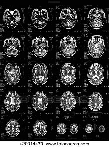 Stock Image - Normal MRI of the brain of a 62 year old woman. Fotosearch