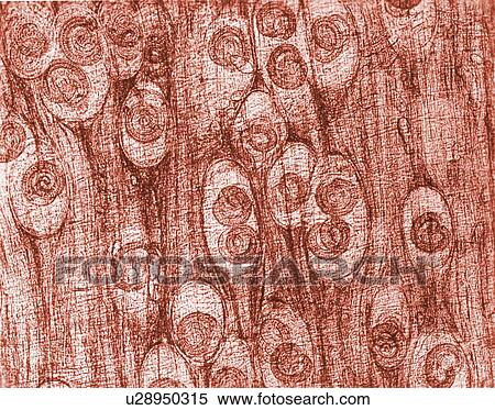 Stock Photography - "Photomicrograph of Trichinella spiralis cysts seen embedded in a muscle tissue specimen, in a case of trichinellosis". Fotosearch