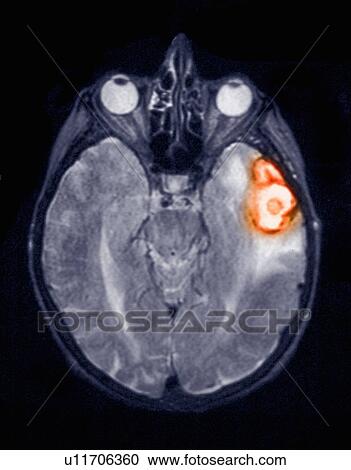 Stock Image - Temporoparietal brain hemorrhage in a 77 year old female shown on an MRI scan. Fotosearch
