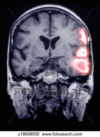Stock Image - Temporoparietal brain hemorrhage in a 77 year old female shown on an MRI scan. Fotosearch
