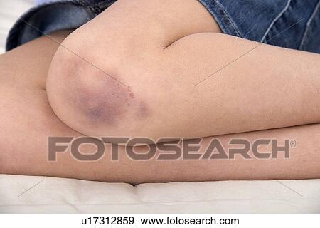 Girl with a bruised knee. View Large Photo Image Stock Photo - Girl with a bruised knee.. Fotosearch
