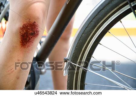 Cropped view of bicycle and girls leg with grazed knee View Large Photo Image Picture - Cropped view of bicycle and girls leg with grazed knee. Fotosearch