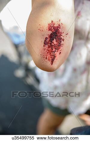 Cropped view of girls arm with grazed elbow, focus on foreground View Large Photo Image Stock Photography - Cropped view of girls arm with grazed elbow, focus on foreground. Fotosearch