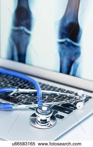 Stock Photography - Modern orthopedics. Acoustic stethoscope on an an laptop computer that displays an anteroposterior X-Ray image of knees. Fotosearch