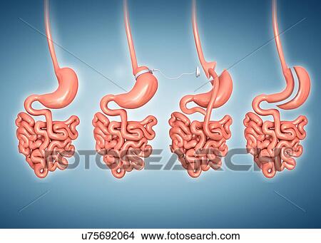 減量 手術 コンピュータ Illustration から 左 へ 権利 Are A 正常 胃 A 胃 バンド A 胃 バイパス そして A 袖 Gastrectomy イラスト U Fotosearch