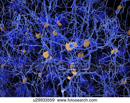 Stock Illustration - Alzheimer's disease. Computer illustration of amyloid plaques amongst neurons. Amyloid plaques are characteristic features of Alzheimer's disease.. Fotosearch