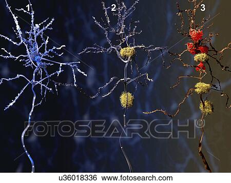 Stock Illustration - Alzheimer's disease. Computer illustration of a healthy neuron (left), a neuron with amyloid plaques (yellow, centre), and a dead neuron being digested by microglia cells (red, right).. Fotosearch