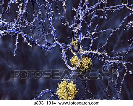Stock Illustration - Alzheimer's disease. Computer illustration of amyloid plaques amongst neurons. Amyloid plaques are characteristic features of Alzheimer's disease.. Fotosearch