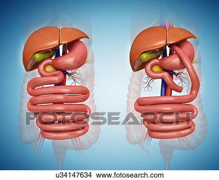 Computer illustration of the abdomen before (left) and after (right) a gastric bypass. View Large Illustration Stock Illustration - Computer illustration of the abdomen before (left) and after (right) a gastric bypass.. Fotosearch
