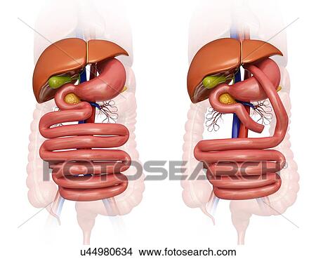 Computer illustration of the abdomen before (left) and after (right) a gastric bypass. View Large Illustration Stock Illustration - Computer illustration of the abdomen before (left) and after (right) a gastric bypass.. Fotosearch