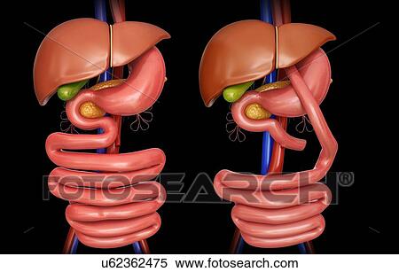 Stock Illustration - Computer illustration of the abdomen before (left) and after (right) a gastric bypass.. Fotosearch