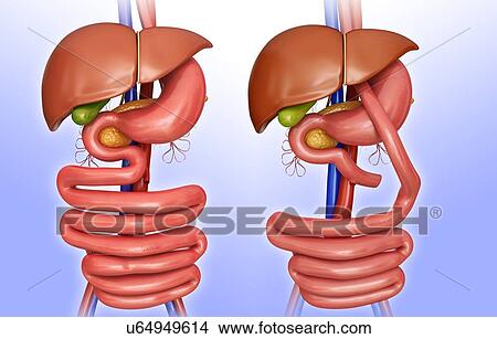 Stock Illustration - Computer illustration of the abdomen before (left) and after (right) a gastric bypass.. Fotosearch