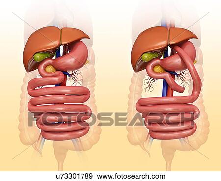 Stock Illustration - Computer illustration of the abdomen before (left) and after (right) a gastric bypass.. Fotosearch