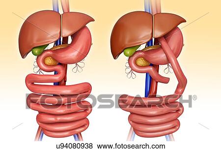Stock Illustration - Computer illustration of the abdomen before (left) and after (right) a gastric bypass.. Fotosearch