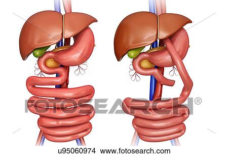 Stock Illustration - Computer illustration of the abdomen before (left) and after (right) a gastric bypass.. Fotosearch