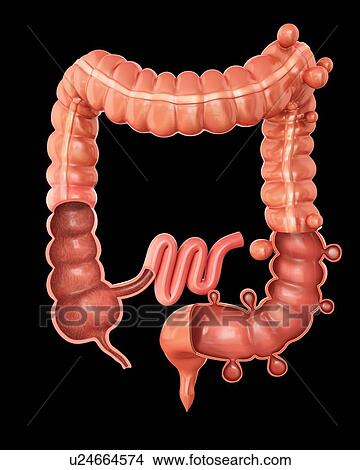 Cross section of a human large intestine showing diverticulitis, computer illustration. View Large Illustration Stock Illustration - Cross section of a human large intestine showing diverticulitis, computer illustration.. Fotosearch