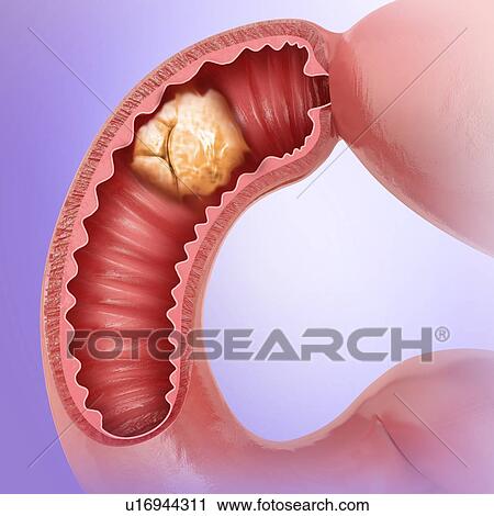 Cross section of a tumour in the small intestine, computer illustration. View Large Illustration Clip Art - Cross section of a tumour in the small intestine, computer illustration.. Fotosearch