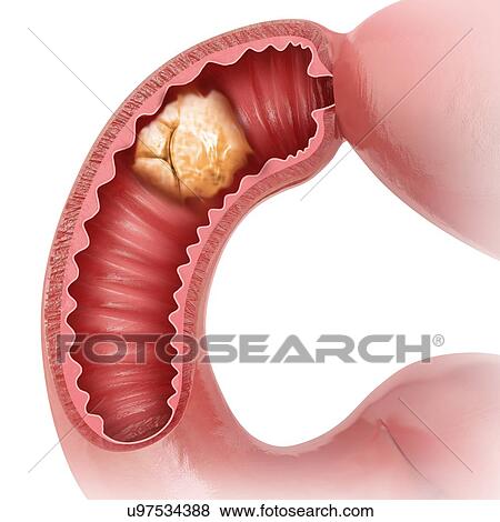 Cross section of an abnormal human small intestine, computer illustration. View Large Illustration Stock Illustration - Cross section of an abnormal human small intestine, computer illustration.. Fotosearch