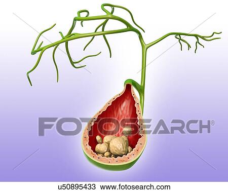 Drawing - Cross section of human gall bladder with gall stones, computer artwork.. Fotosearch
