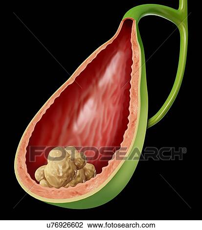 Cross section of human gall bladder with gall stones, computer artwork. View Large Illustration Drawing - Cross section of human gall bladder with gall stones, computer artwork.. Fotosearch