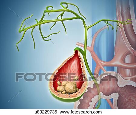 Cross section of human gall bladder with gall stones, computer artwork. View Large Illustration Stock Illustration - Cross section of human gall bladder with gall stones, computer artwork.. Fotosearch