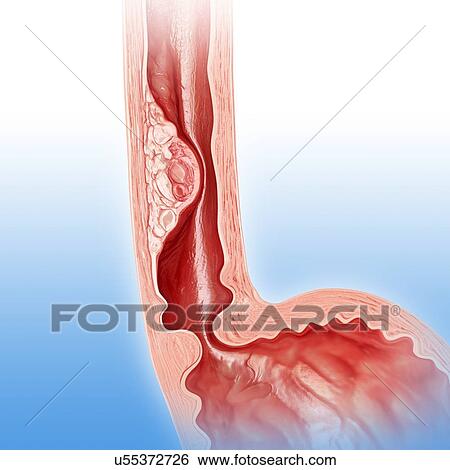 Cross section of human stomach cancer, computer illustration. View Large Illustration Stock Illustration - Cross section of human stomach cancer, computer illustration.. Fotosearch