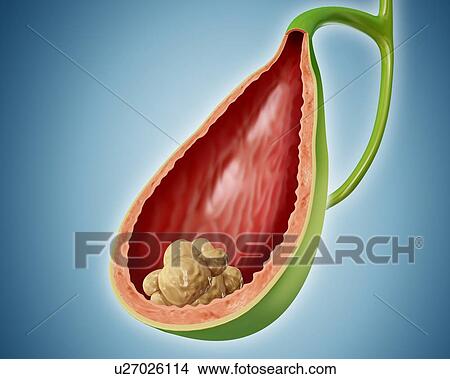 Stock Illustration - Cross section of the human gall bladder with gall stones, computer illustration.. Fotosearch