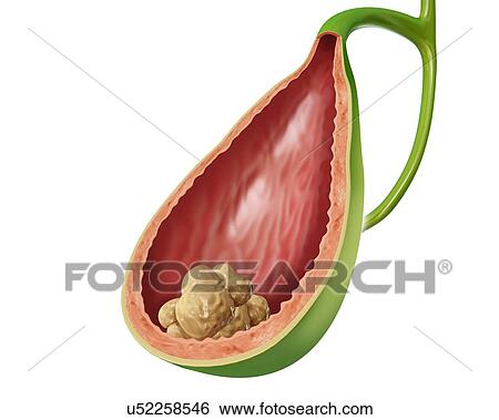 Stock Illustration - Cross section of the human gall bladder showing gall stone, computer illustration.. Fotosearch