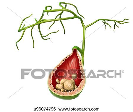 Cross section of the human gall bladder with gall stones, computer artwork. View Large Illustration Stock Illustration - Cross section of the human gall bladder with gall stones, computer artwork.. Fotosearch