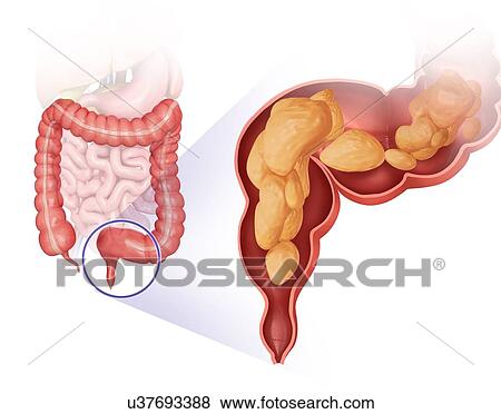Cross section of the human large intestine and solid waste, computer artwork. View Large Illustration Stock Illustration - Cross section of the human large intestine and solid waste, computer artwork.. Fotosearch