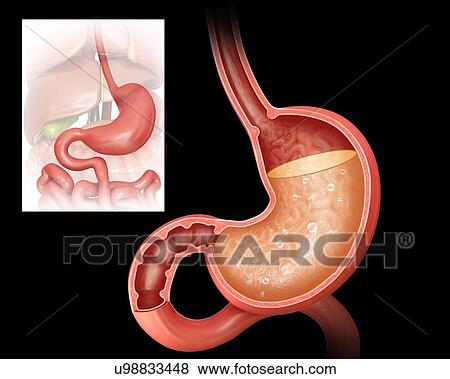 Cross section of the human stomach showing acidity levels, computer illustration. View Large Illustration Stock Illustration - Cross section of the human stomach showing acidity levels, computer illustration.. Fotosearch