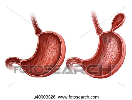 Cross section of the human stomach with and without a hernia, computer illustration. View Large Illustration Stock Illustration - Cross section of the human stomach with and without a hernia, computer illustration.. Fotosearch