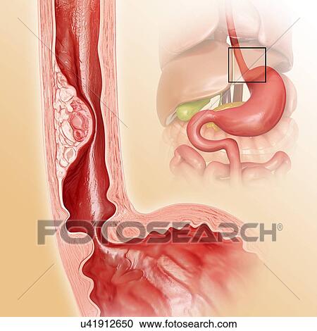 Cross section showing human oesophageal cancer, computer artwork. View Large Illustration Clipart - Cross section showing human oesophageal cancer, computer artwork.. Fotosearch