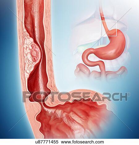 Stock Illustration - Cross section showing human oesophageal cancer, computer artwork.. Fotosearch