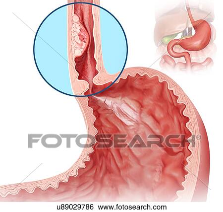 Cross section showing human oesophageal cancer, computer artwork. View Large Illustration Stock Illustration - Cross section showing human oesophageal cancer, computer artwork.. Fotosearch
