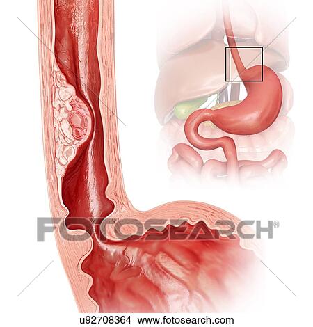 Stock Illustration - Cross section showing human oesophageal cancer, computer artwork.. Fotosearch
