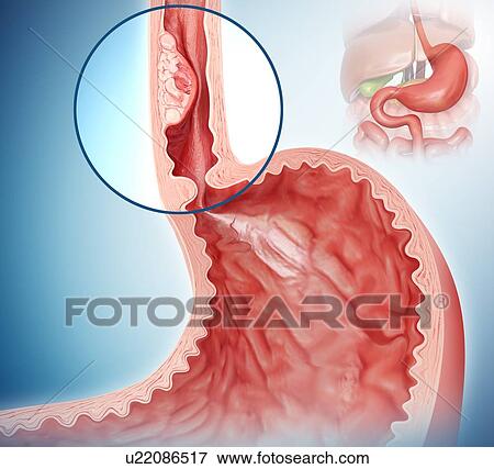 Cross section showing human stomach cancer, computer illustration. View Large Illustration Stock Illustration - Cross section showing human stomach cancer, computer illustration.. Fotosearch