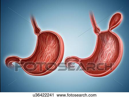 Clip Art - Cross section the human stomach with and without a hernia, computer illustration.. Fotosearch