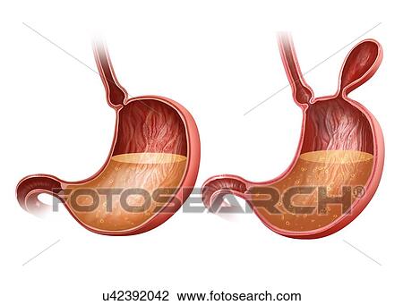 Cross section the human stomach with and without a hernia, computer artwork. View Large Illustration Drawing - Cross section the human stomach with and without a hernia, computer artwork.. Fotosearch